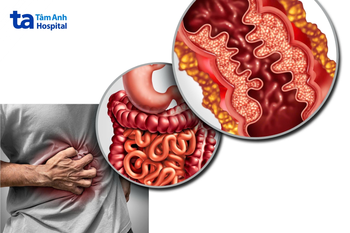 bệnh Crohn điều trị được không
