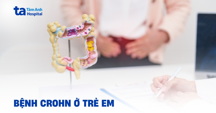 Bệnh Crohn ở trẻ em điều trị như thế nào?