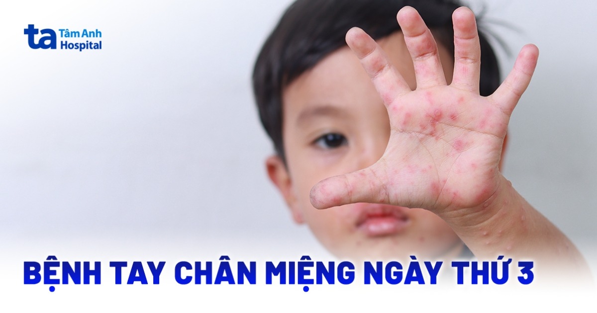 Vì sao tay chân miệng ngày thứ 3 cần theo dõi sát sao?