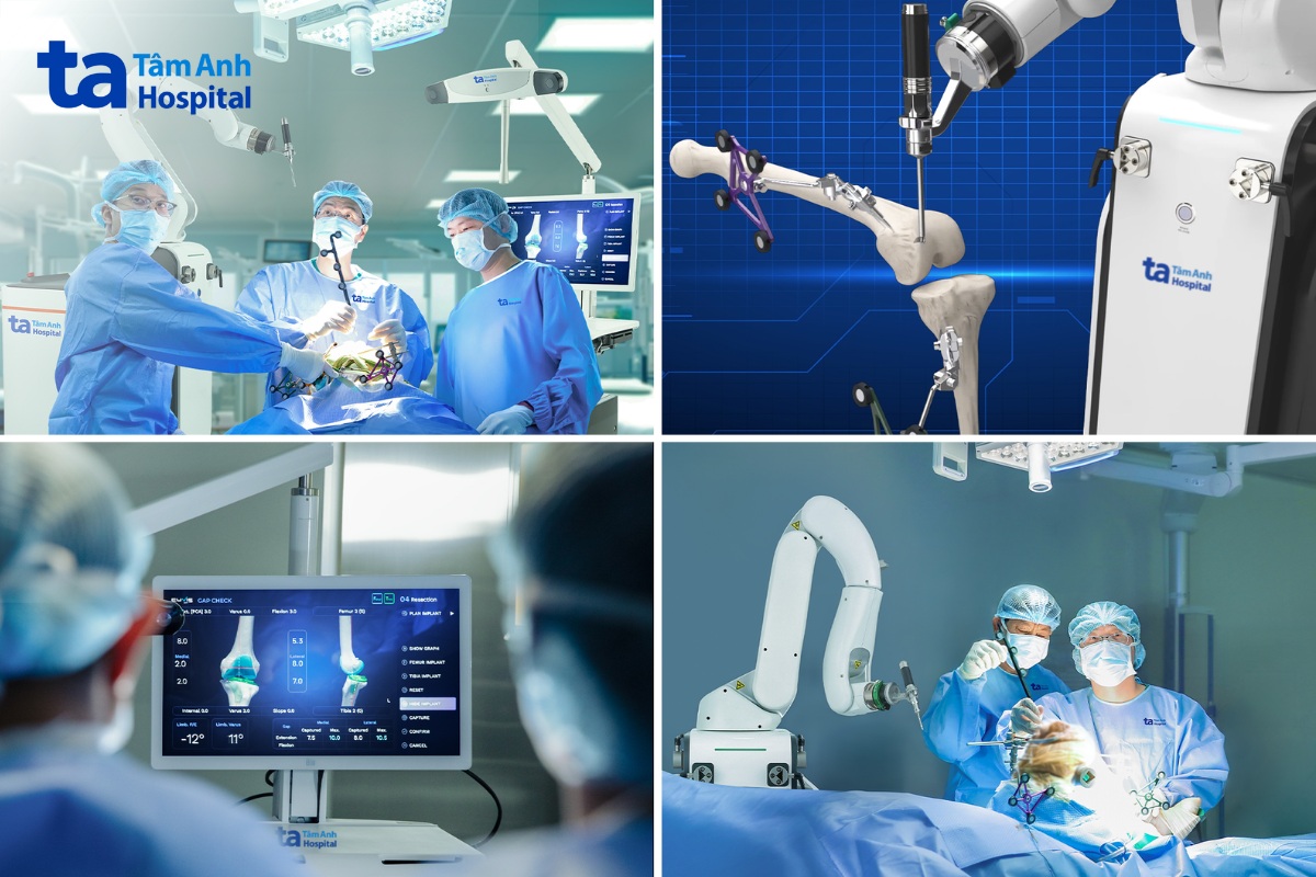 Các bác sĩ Tâm Anh đang phẫu thuật một trong hơn 100 ca thay khớp đầu tiên bằng robot AI CUVIS-Joint.