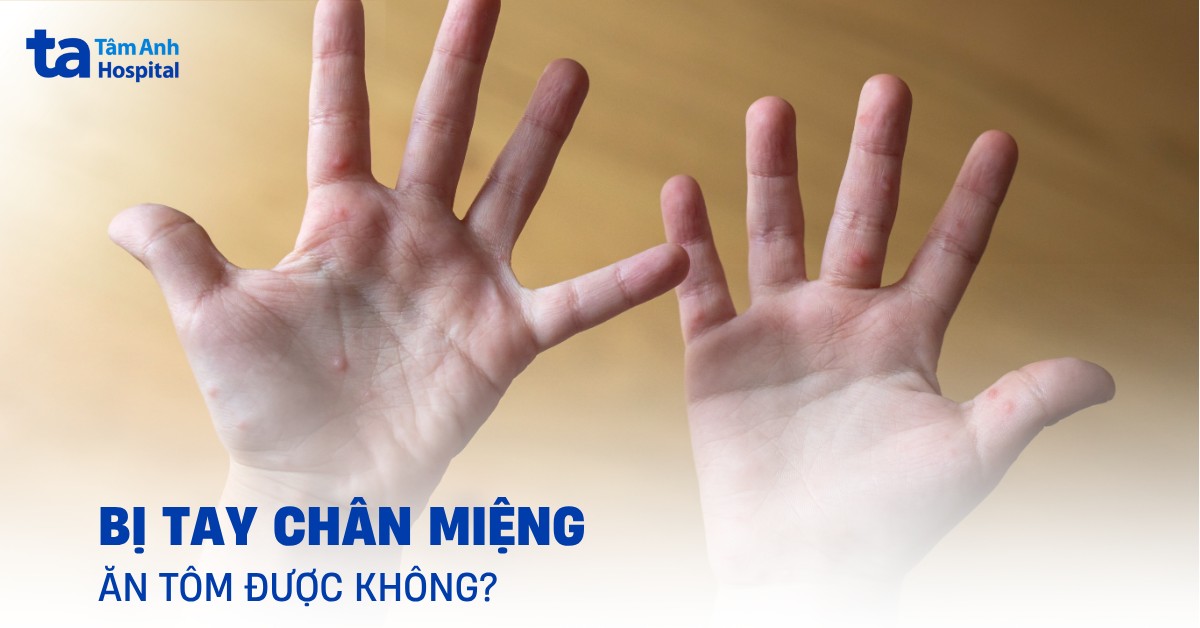 Bé bị tay chân miệng ăn tôm được không? Cần lưu ý những gì?
