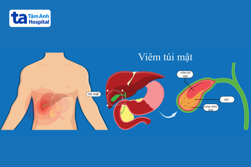 bị viêm túi mật
