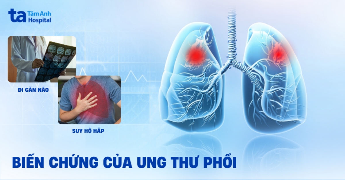 Biến Chứng Của Ung Thư Phổi
