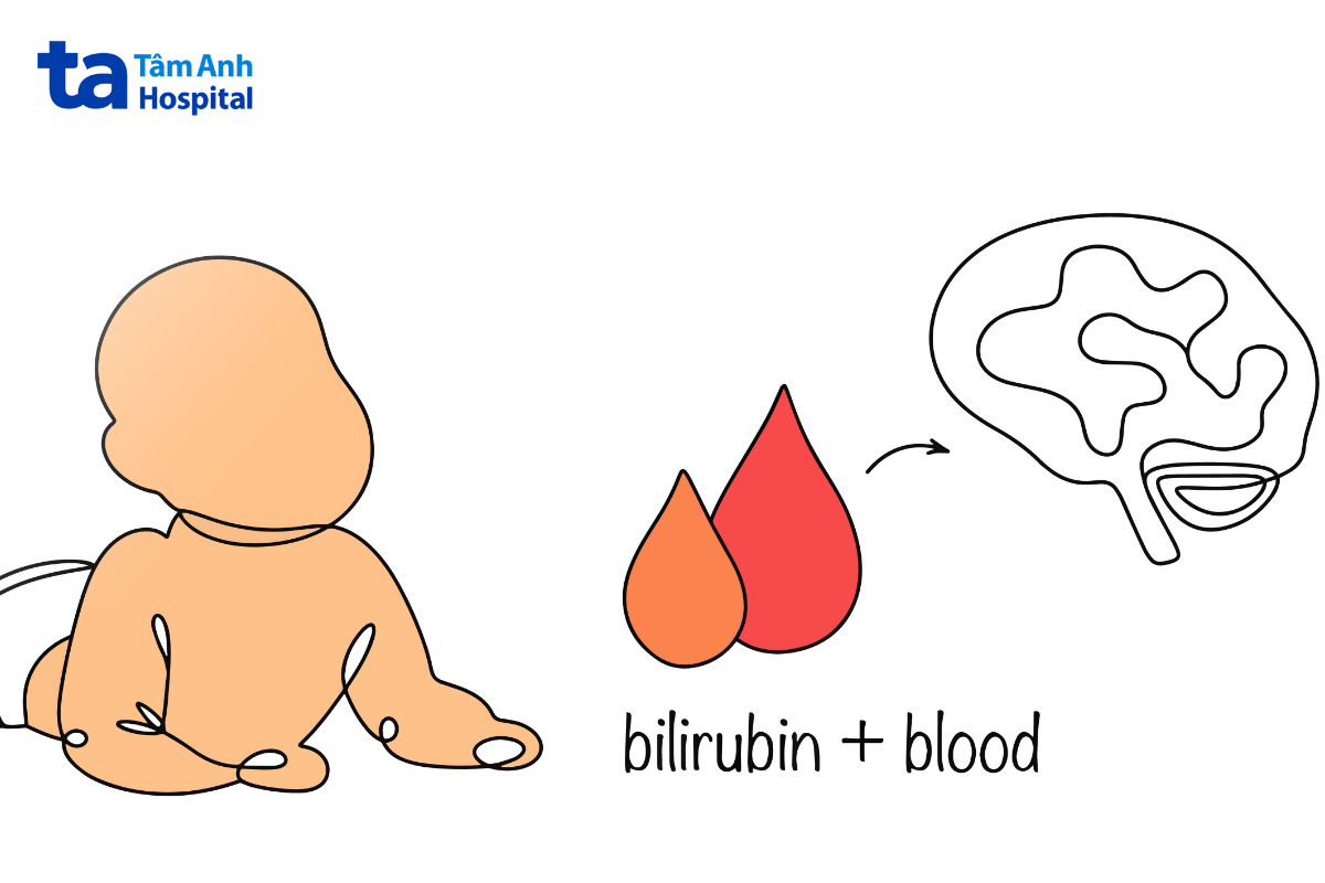 bilirubin tích tụ quá mức