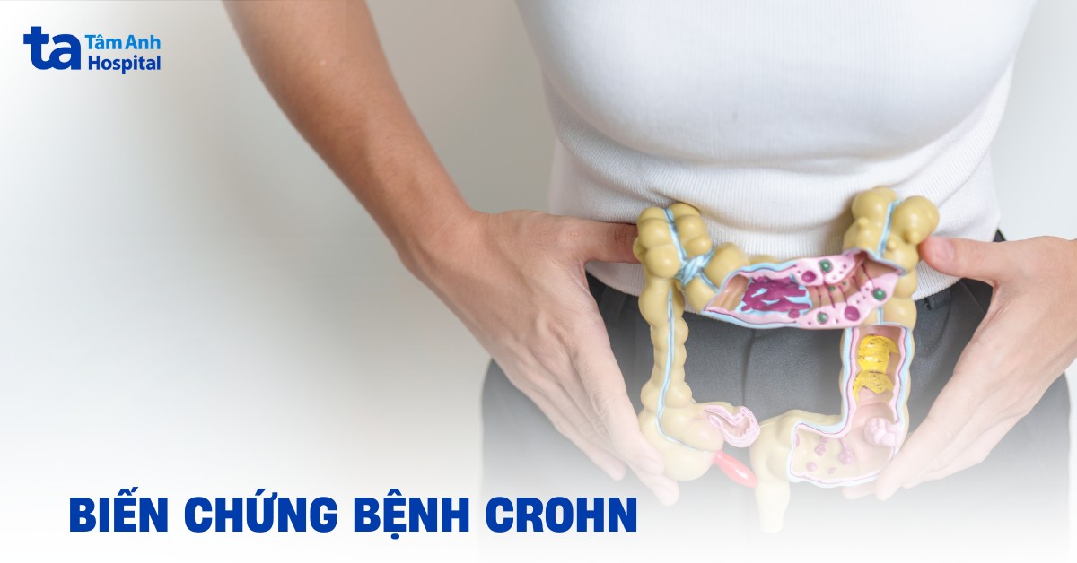 Các Biến Chứng Bệnh Crohn