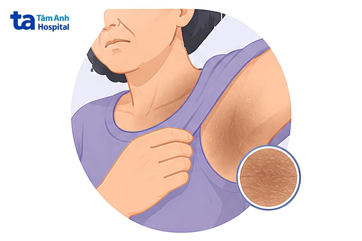 các mảng da sẫm màu, dày và nhám ở cổ, nách hoặc bẹn