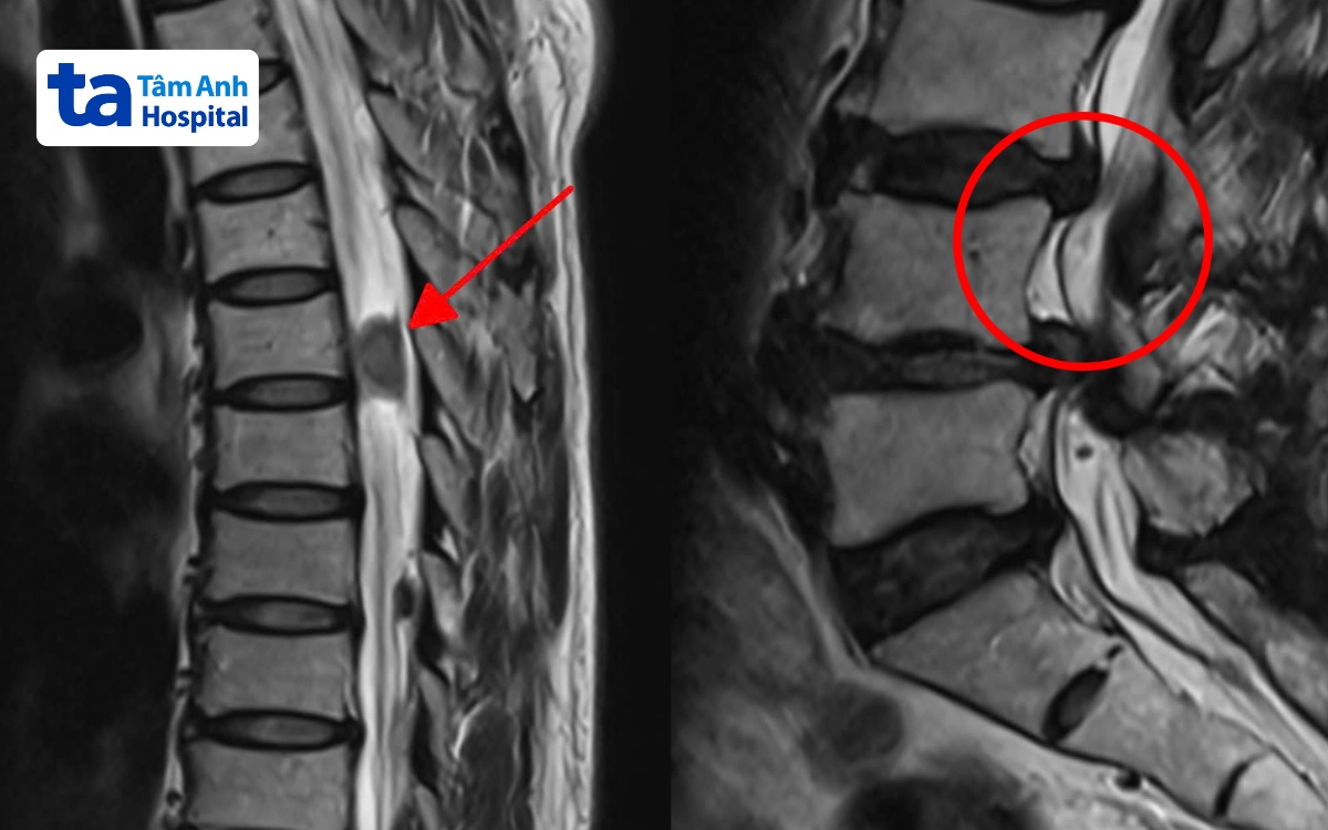 Kết quả chụp MRI vị trí khối u (trái) và tổn thương đĩa đệm của bà Láng. 