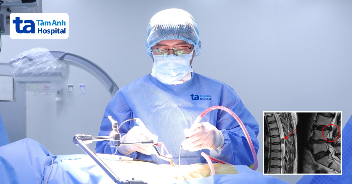 Cam go tắt máy tạo nhịp tim để mổ cột sống cho người bệnh