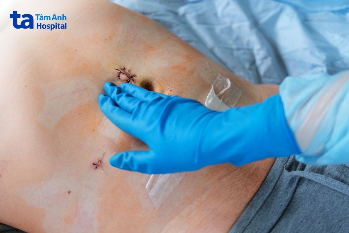 chăm sóc 3 lỗ mổ ruột thừa