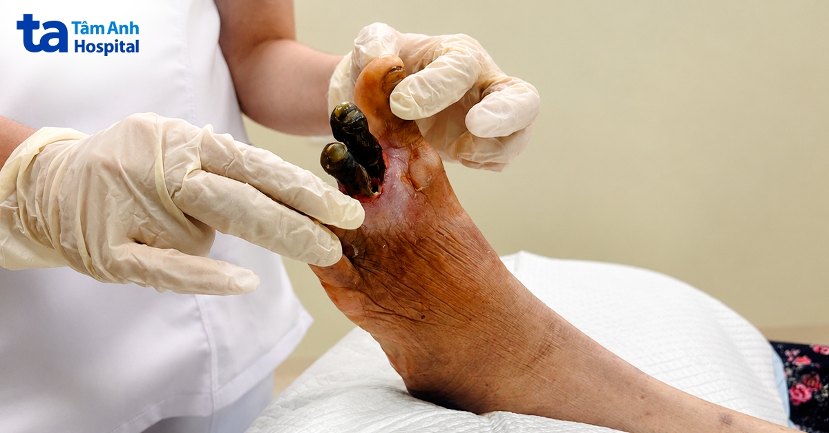 chân bà kim đã hoại tử 2 ngón, nhiễm trùng lan rộng, nguy cơ phải cắt bỏ cả bàn chân