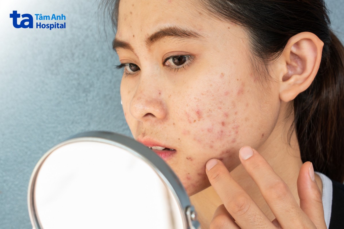 chỉ định điều trị bằng aviclear