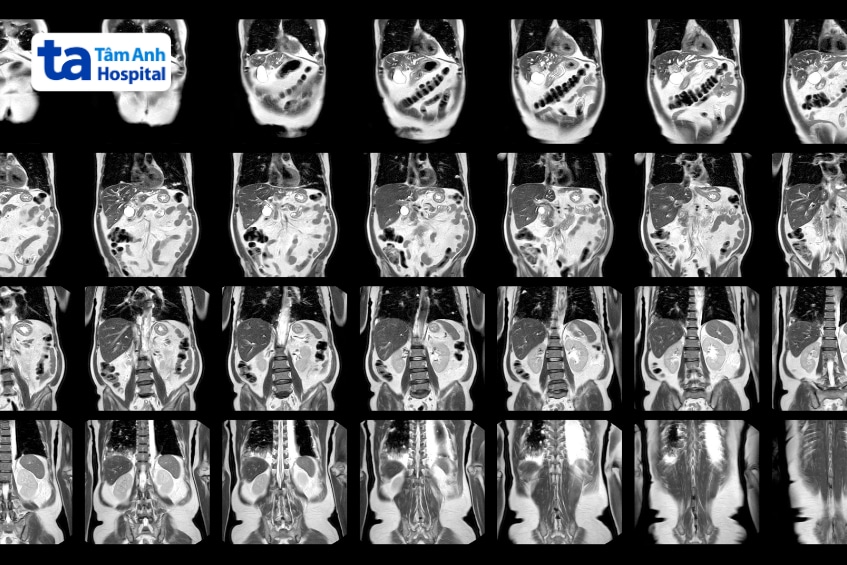 Hình ảnh MRI hỗ trợ bác sĩ chẩn đoán và đánh giá u Klatskin.
