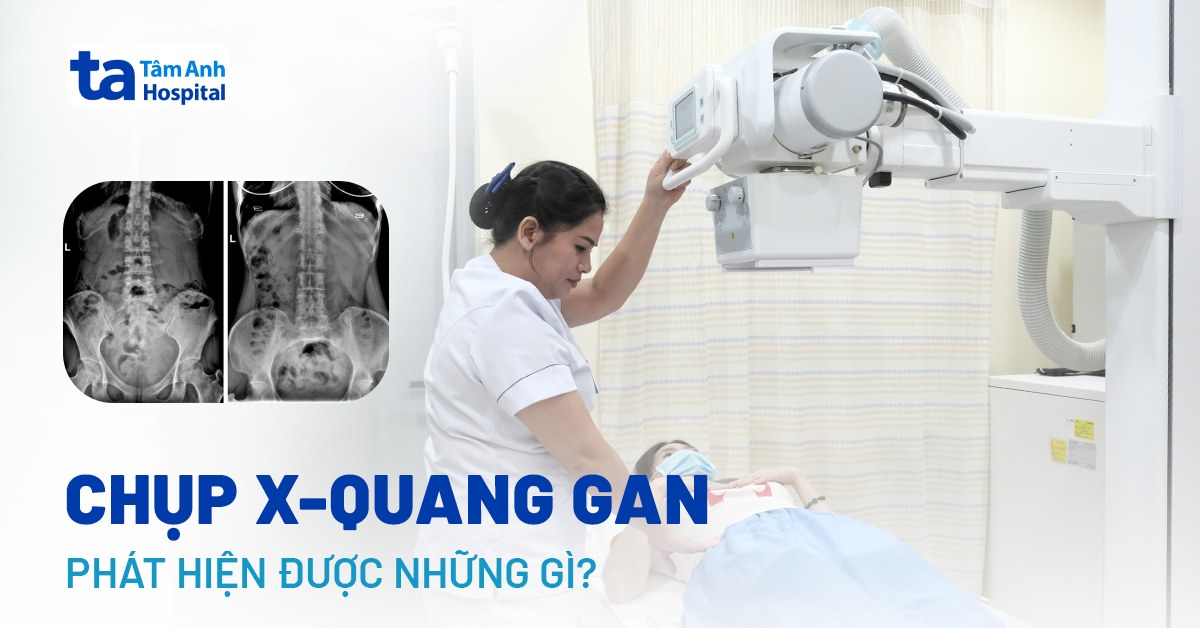 Chụp X-Quang Gan