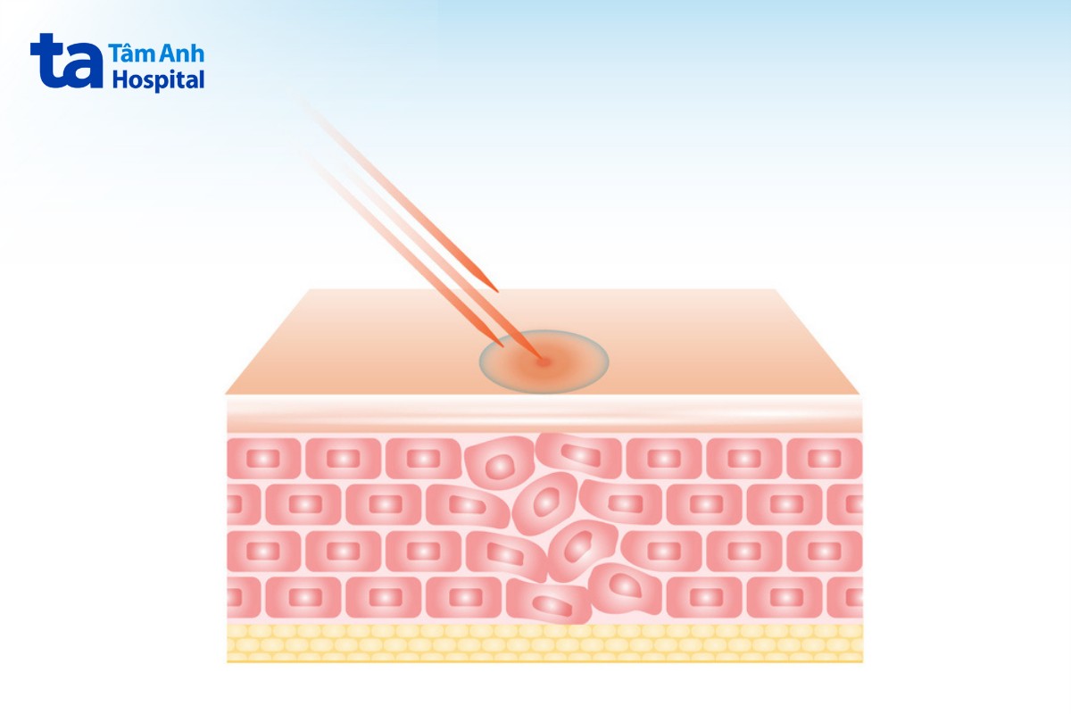 công dụng máy plasma gold