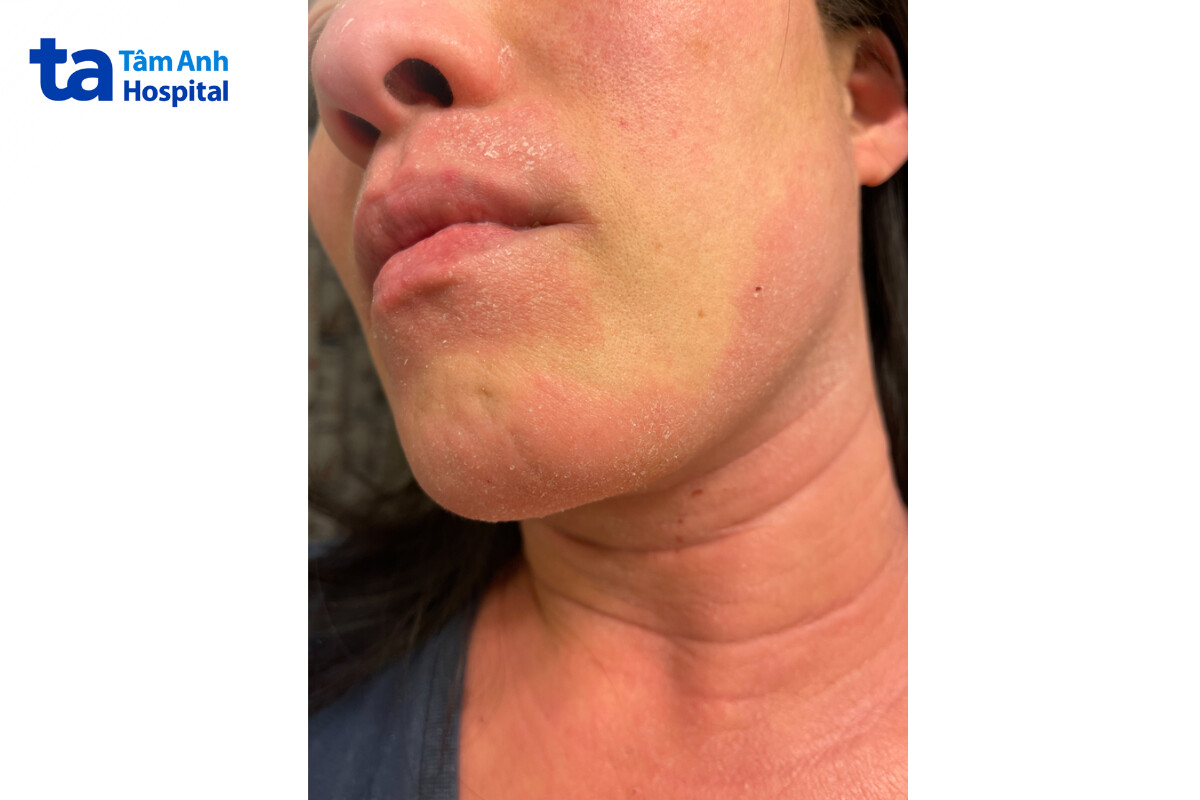 da nhiễm corticoid cần thời gian dài để phục hồi