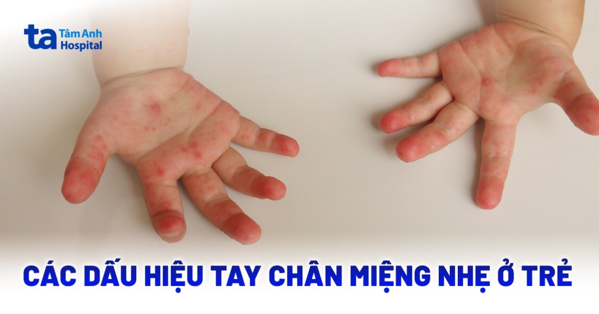 Cảnh giác các dấu hiệu tay chân miệng nhẹ mới chớm phát sinh
