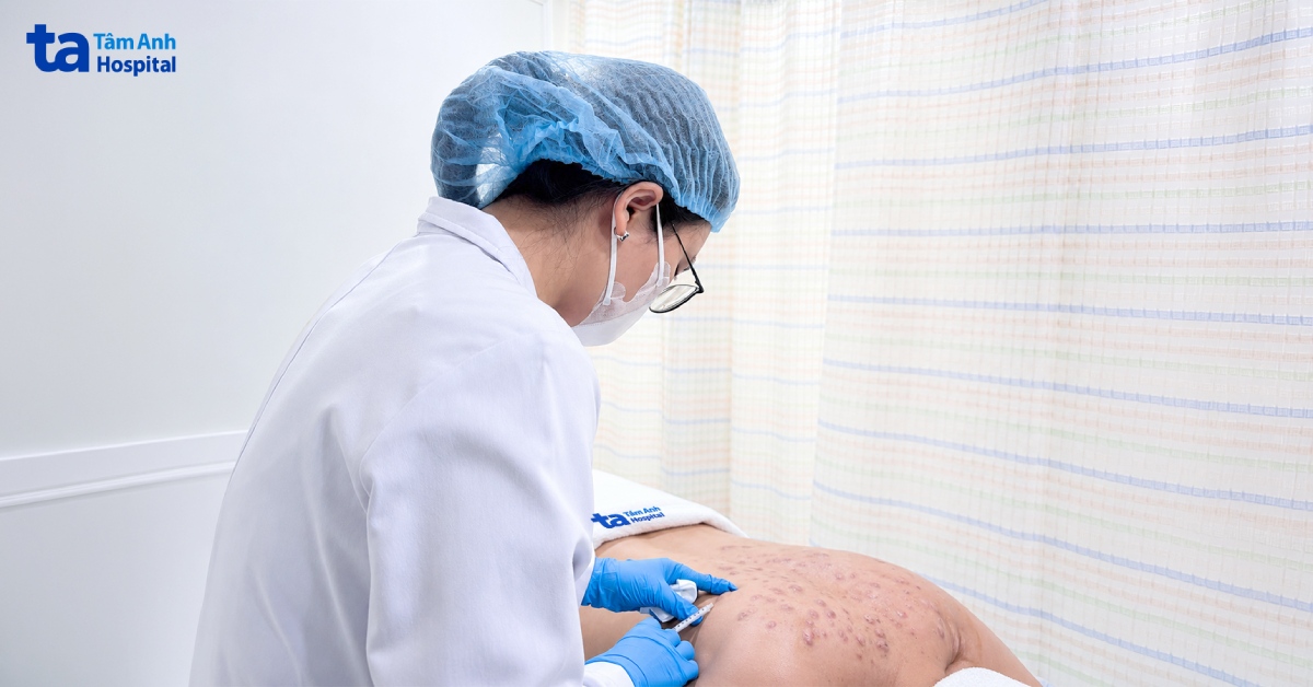 Điều trị sẹo kín lưng cho nam thanh niên