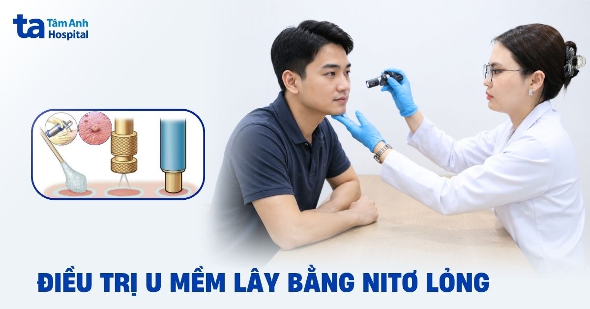 Điều trị u mềm lây bằng nitơ lỏng: Tìm hiểu chi tiết