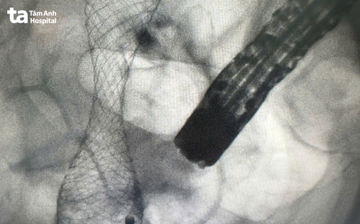 đoạn stent kim loại