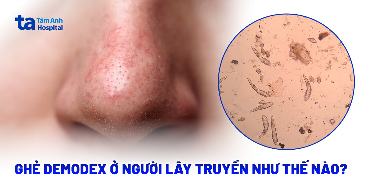 Ghẻ demodex ở người lây truyền như thế nào?