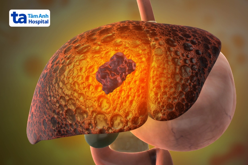 hemangioma gan là khối u lành tính