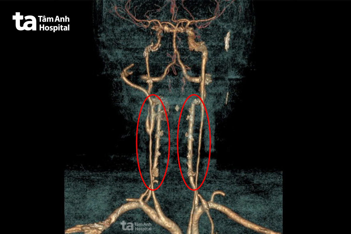 Hình ảnh chụp CT cho thấy hai nhánh động mạch cảnh của bệnh nhân hẹp khít nhiều chỗ làm giảm lưu lượng máu nuôi não