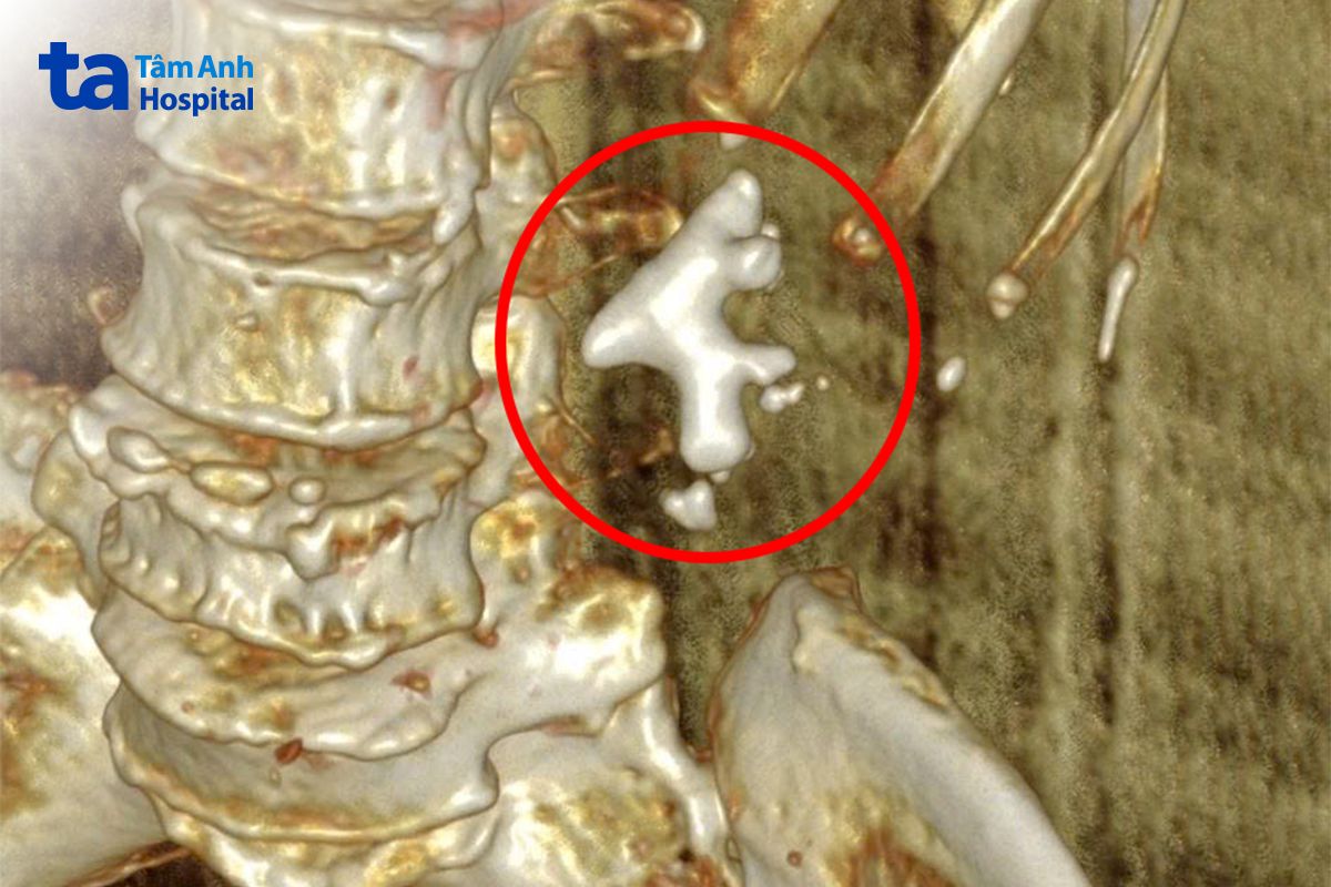 hình ảnh chụp ct ghi nhận sỏi san hô