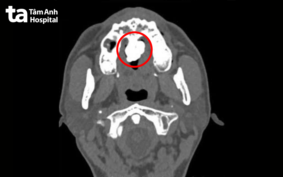 hình ảnh CT khẩu cái vùng họng