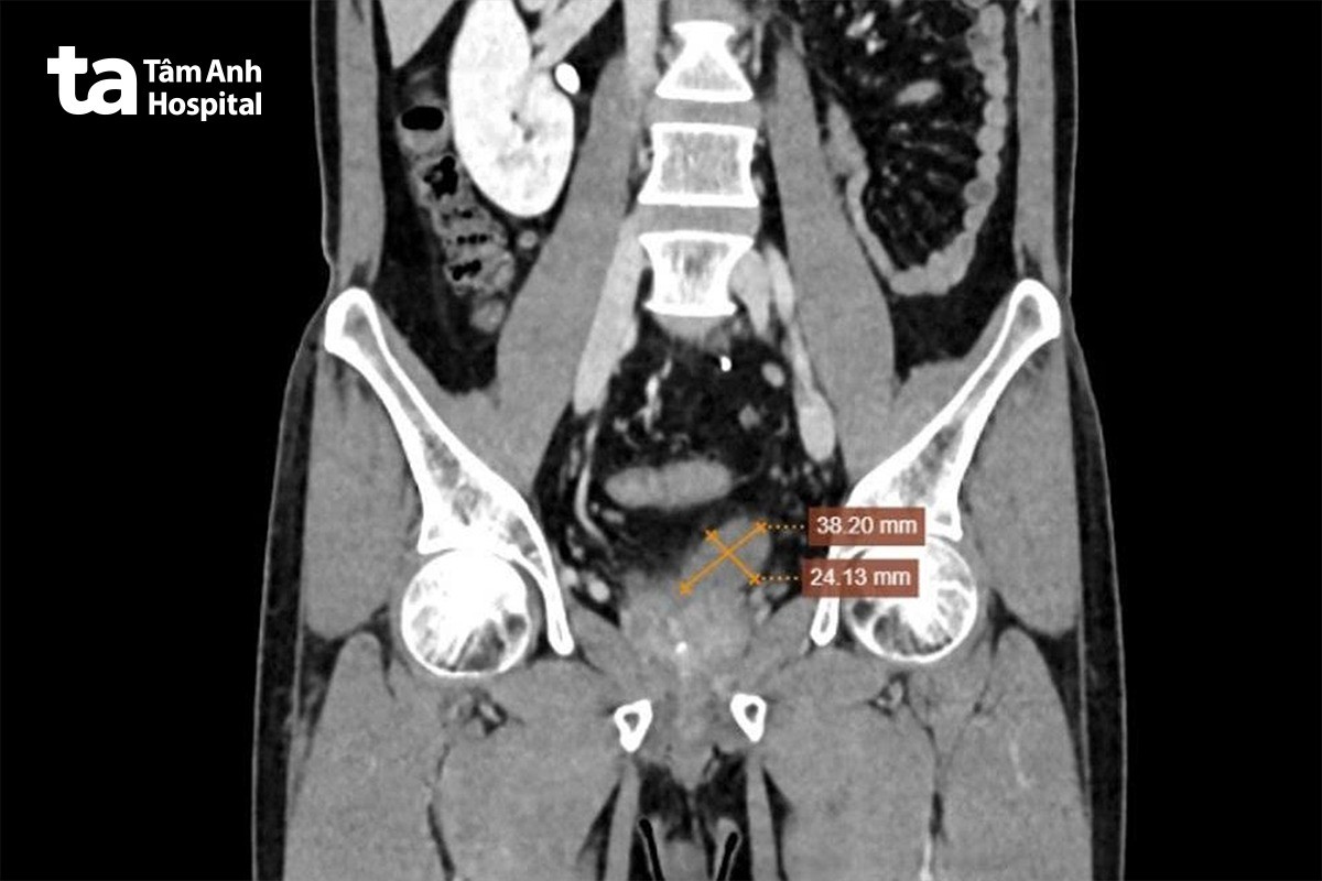 hình ảnh ct túi tinh trái bị viêm