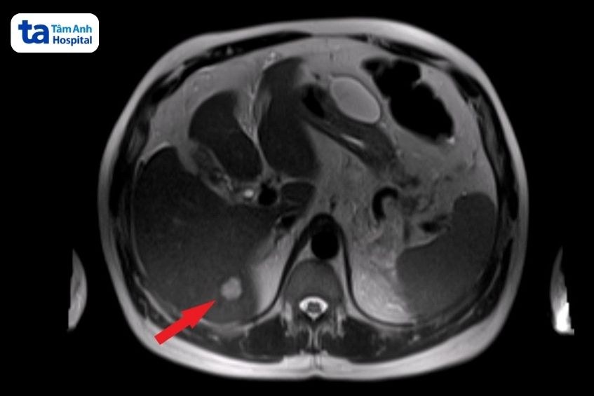 hình ảnh mri khối u gan