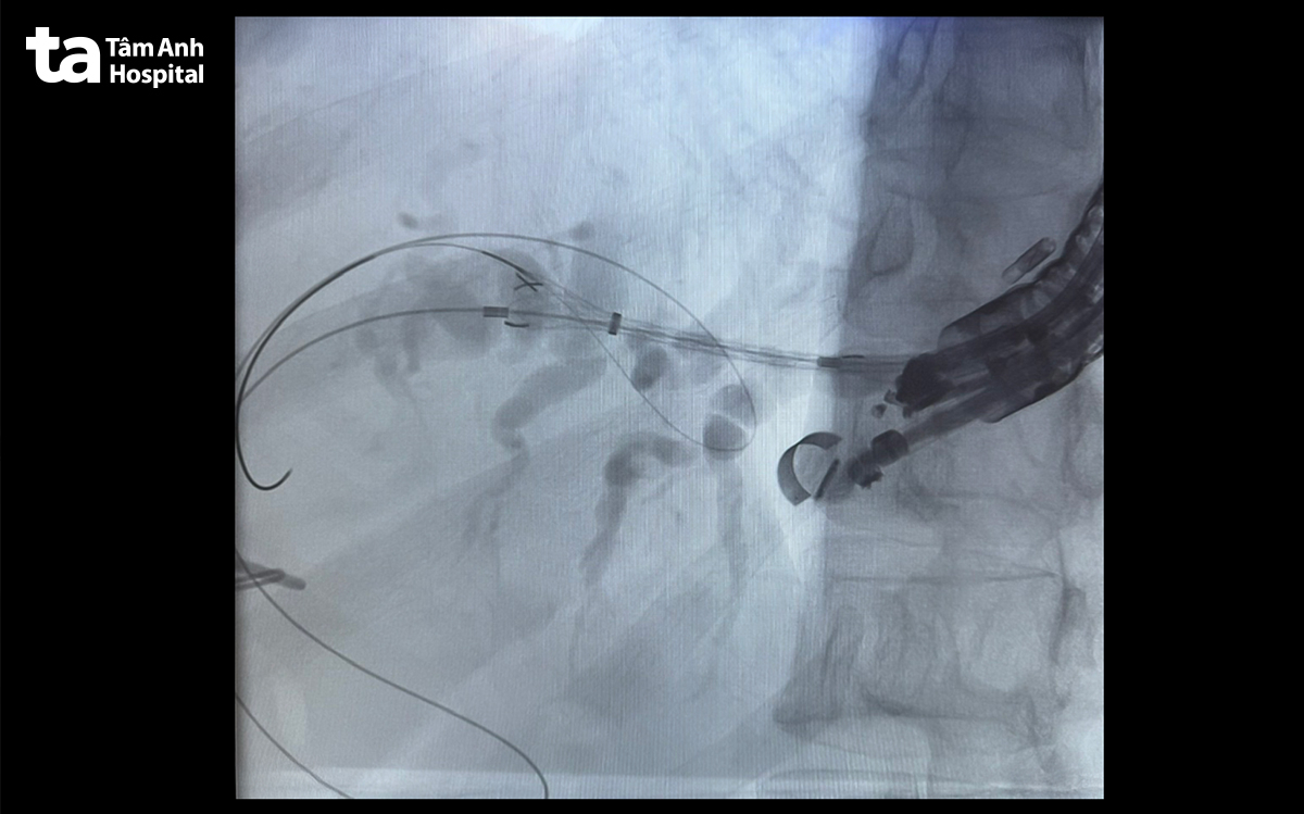 hình ảnh stent được đặt