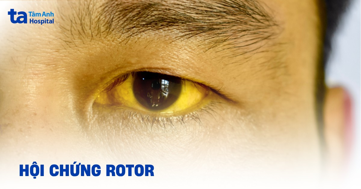 Hội chứng Rotor là gì? Nguyên nhân, chẩn đoán và phòng ngừa