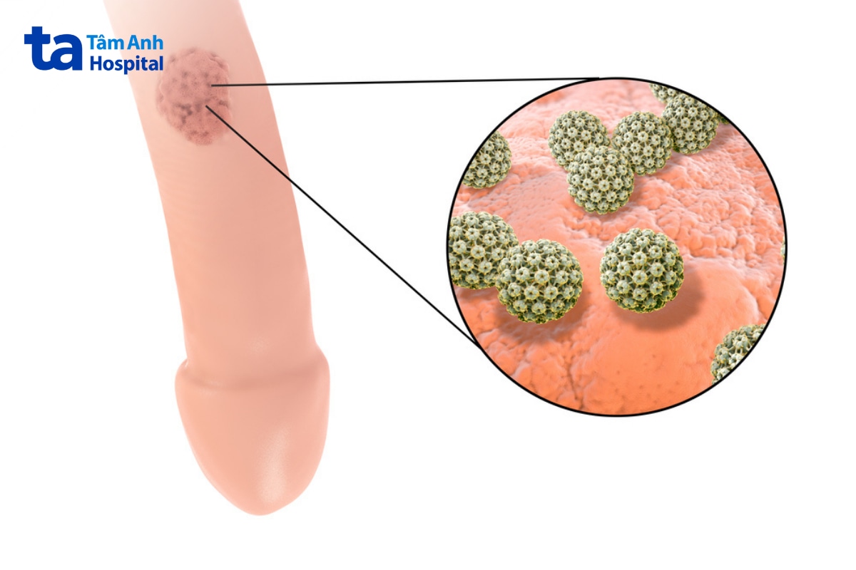 Minh họa HPV gây tổn thương ở cơ quan sinh dục nam