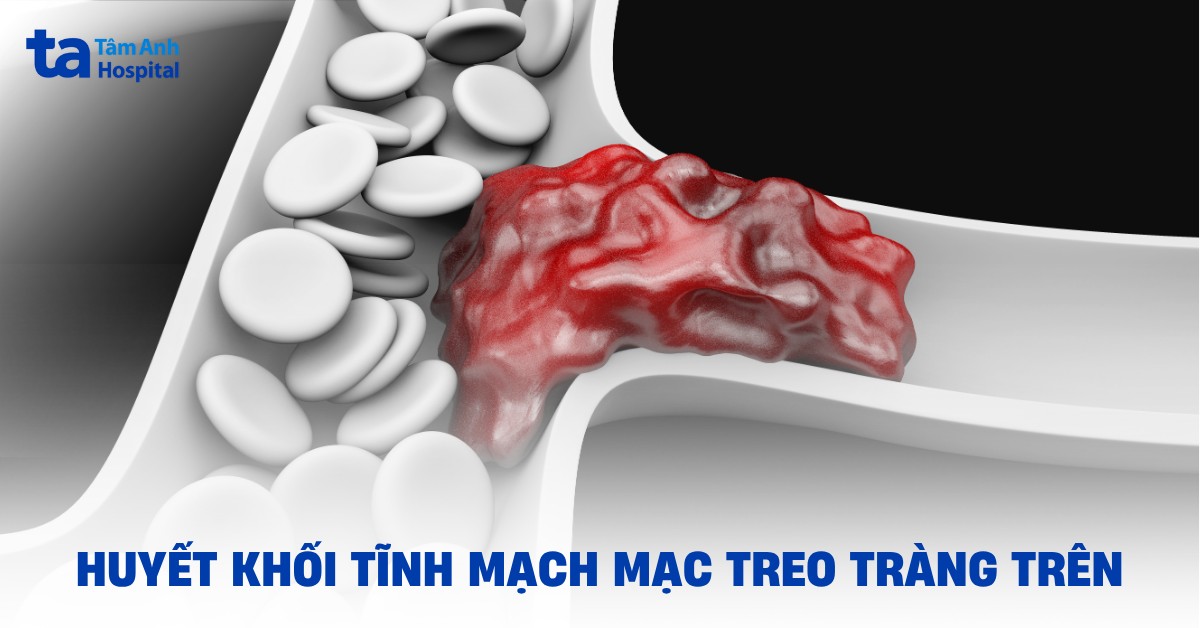 Hiều về bệnh huyết khối tĩnh mạch mạc treo tràng trên