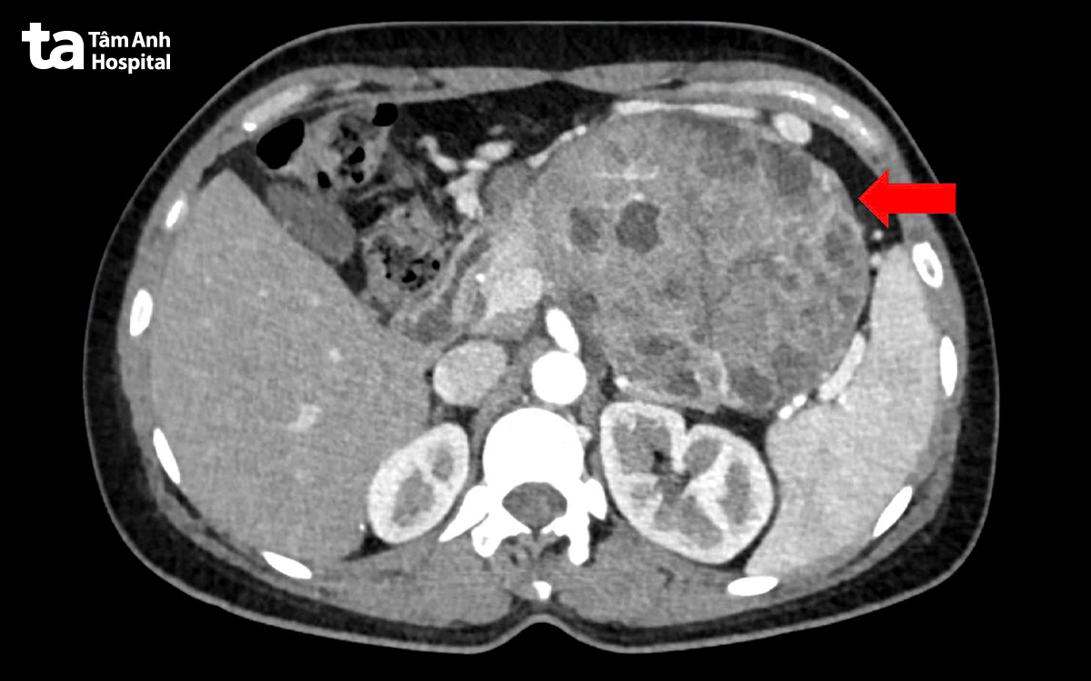 kết quả CT khối u lớn