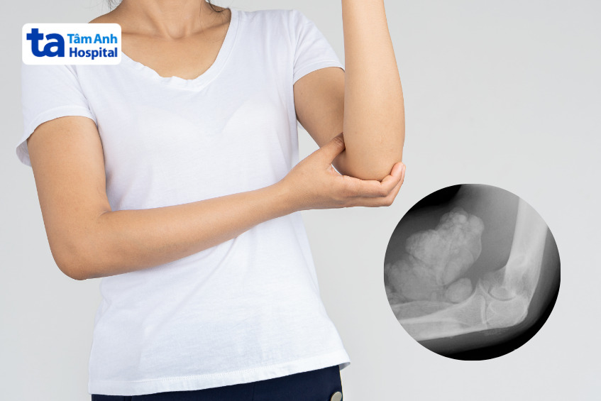 khối u vôi hóa hình thành trong mô mềm