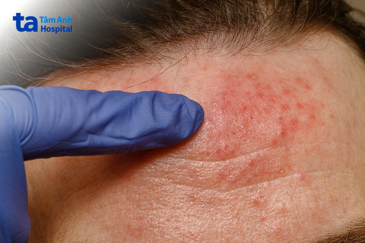 ký sinh trùng demodex có khả năng lây qua tiếp xúc da kề da