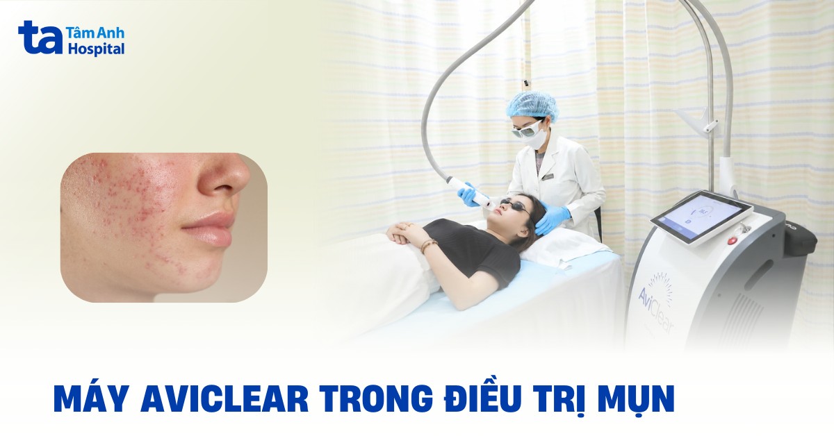 Máy AviClear: Giải pháp điều trị mụn hướng đến hiệu quả lâu dài