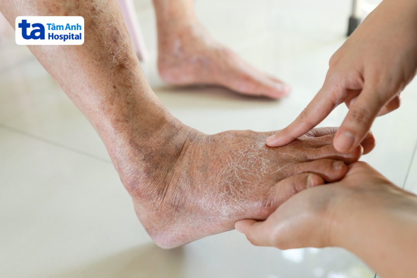 người bệnh tiểu đường dần mất cảm giác bàn chân do tổn thương dây thần kinh