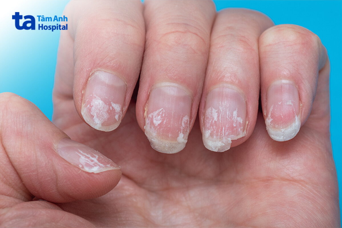 nhận biết viêm da đầu chi liên tục hallopeau