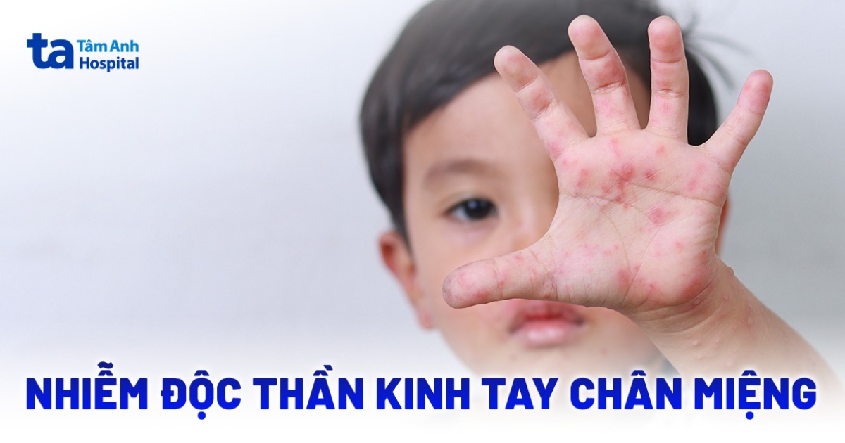 Cảnh báo nhiễm độc thần kinh tay chân miệng không thể lơ là