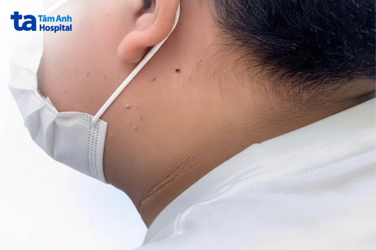 những dấu hiệu liên quan đến bệnh tiểu đường