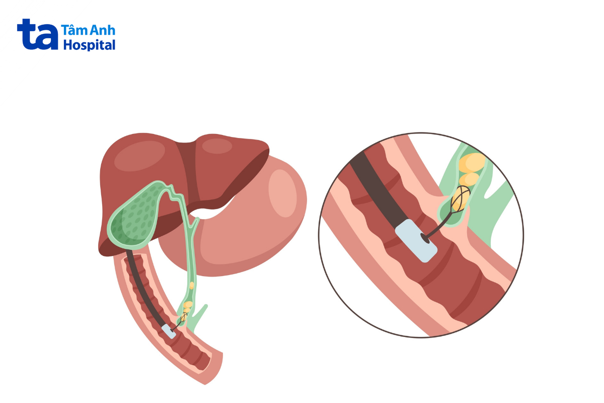Nội soi can thiệp giúp xử lý tắc nghẽn trong đường mật.