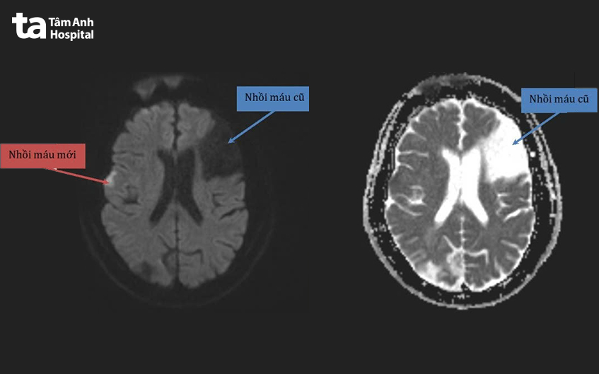 ổ nhồi máu não mới trên mri