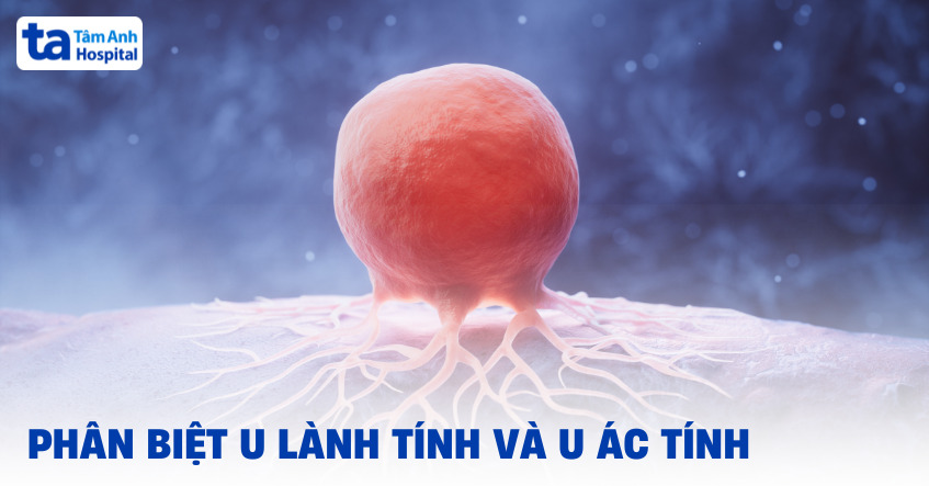 Phân biệt u lành tính và u ác tính như thế nào?