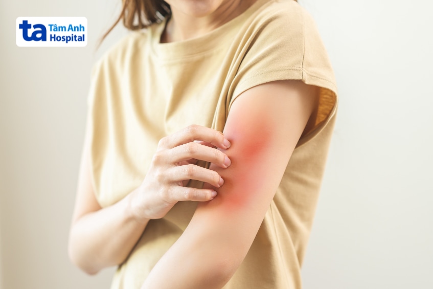 Mebeverine có thể gây phản ứng dị ứng nhẹ trên da