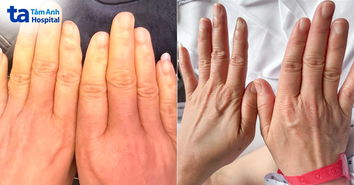 Phát hiện bệnh tự miễn từ đầu ngón tay đổi màu