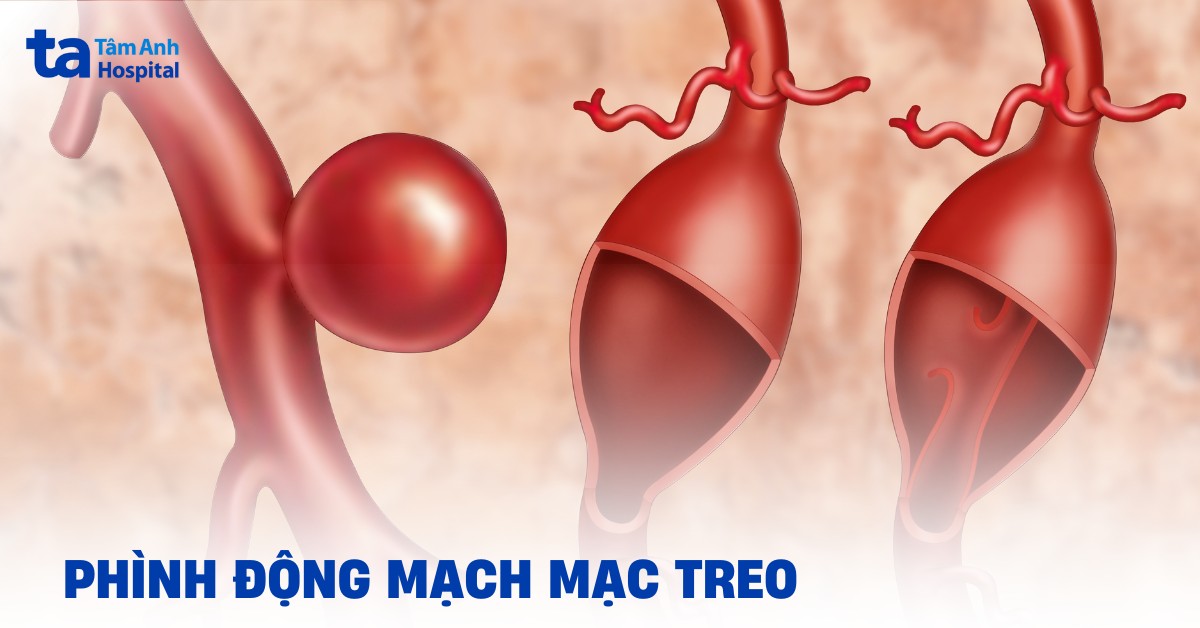 Phình động mạch mạc treo tràng trên có cần can thiệp phẫu thuật?