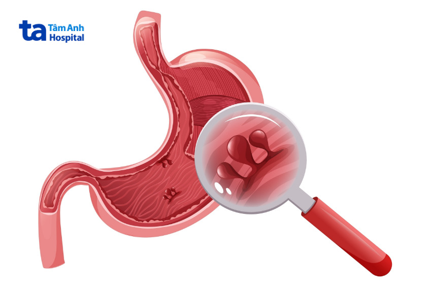 polyp có nguy cơ tiến triển thành ung thư