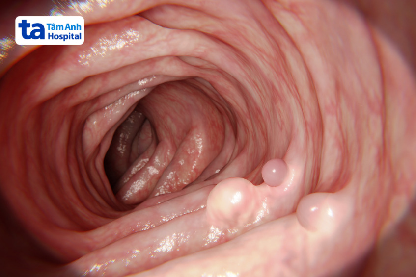 polyp có nhiều loại